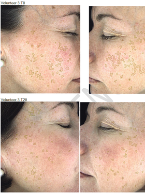 Hyperpigmentation Serum