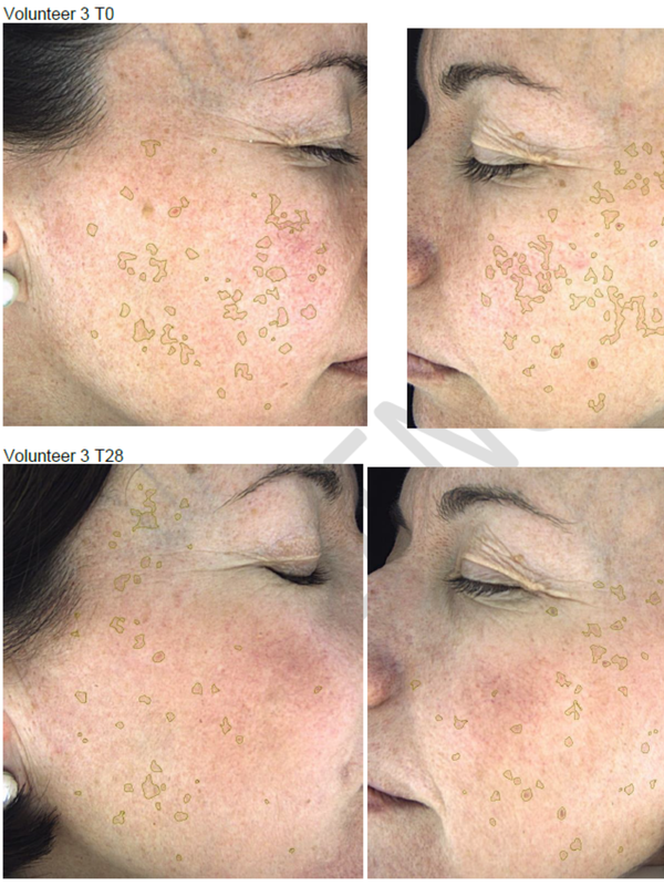 Hyperpigmentation Serum