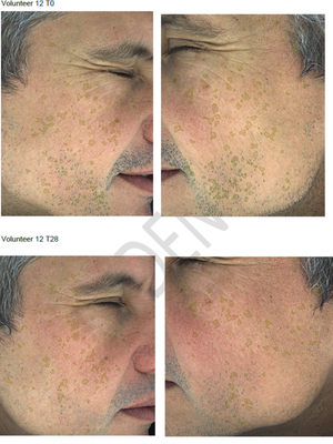 Hyperpigmentation Serum