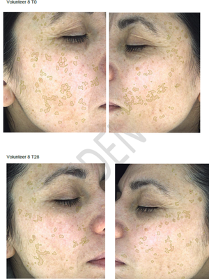 Hyperpigmentation Serum